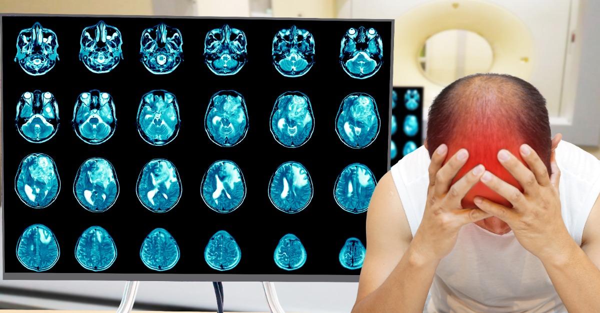 最新「細胞療法」能使高達62%的復發性多形性膠質母細胞瘤患者腫瘤縮小。示意圖。（圖／123RF）