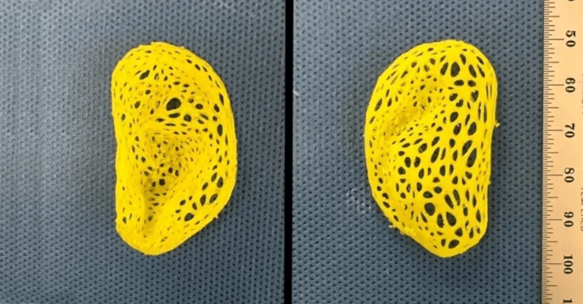 Ear reconstruction