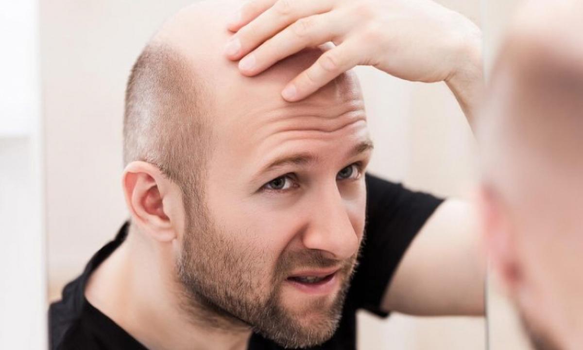 Alopecia areata