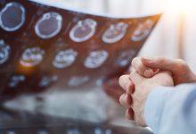 最新「細胞療法」能使高達62%的復發性多形性膠質母細胞瘤患者腫瘤縮小。示意圖。（圖／123RF）