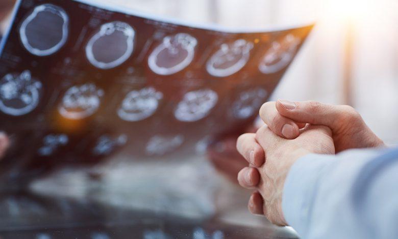 最新「細胞療法」能使高達62%的復發性多形性膠質母細胞瘤患者腫瘤縮小。示意圖。（圖／123RF）