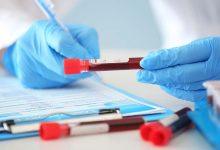 一項最新研究指出，肥胖會加速阿茲海默症相關血液生物標誌物（BBMs）的升高。（圖／123RF）