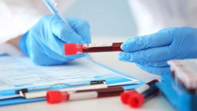 警訊!血液檢測證實:肥胖「加速」阿茲海默症進程高達95% 4 一項最新研究指出,肥胖會加速阿茲海默症相關血液生物標誌物(BBMs)的升高。(圖/123RF)